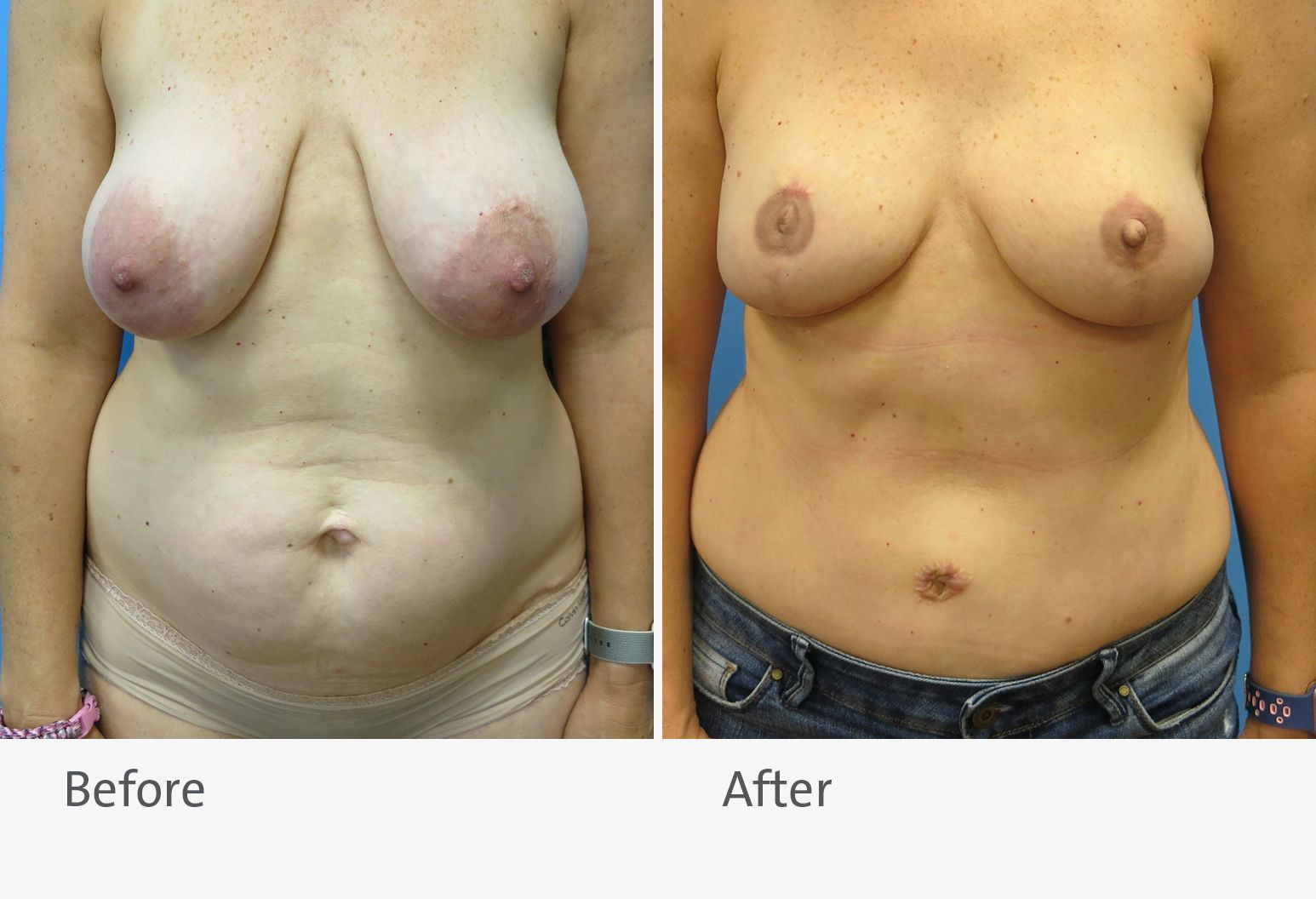 A patient is shown before and after breast reconstruction with a DIEP flap. On the left is the patient before the surgery with large, drooping breasts, and on the right is the patient after surgery with smaller breasts.